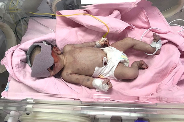 Çöpte bulunan bebek yaşam savaşı veriyor